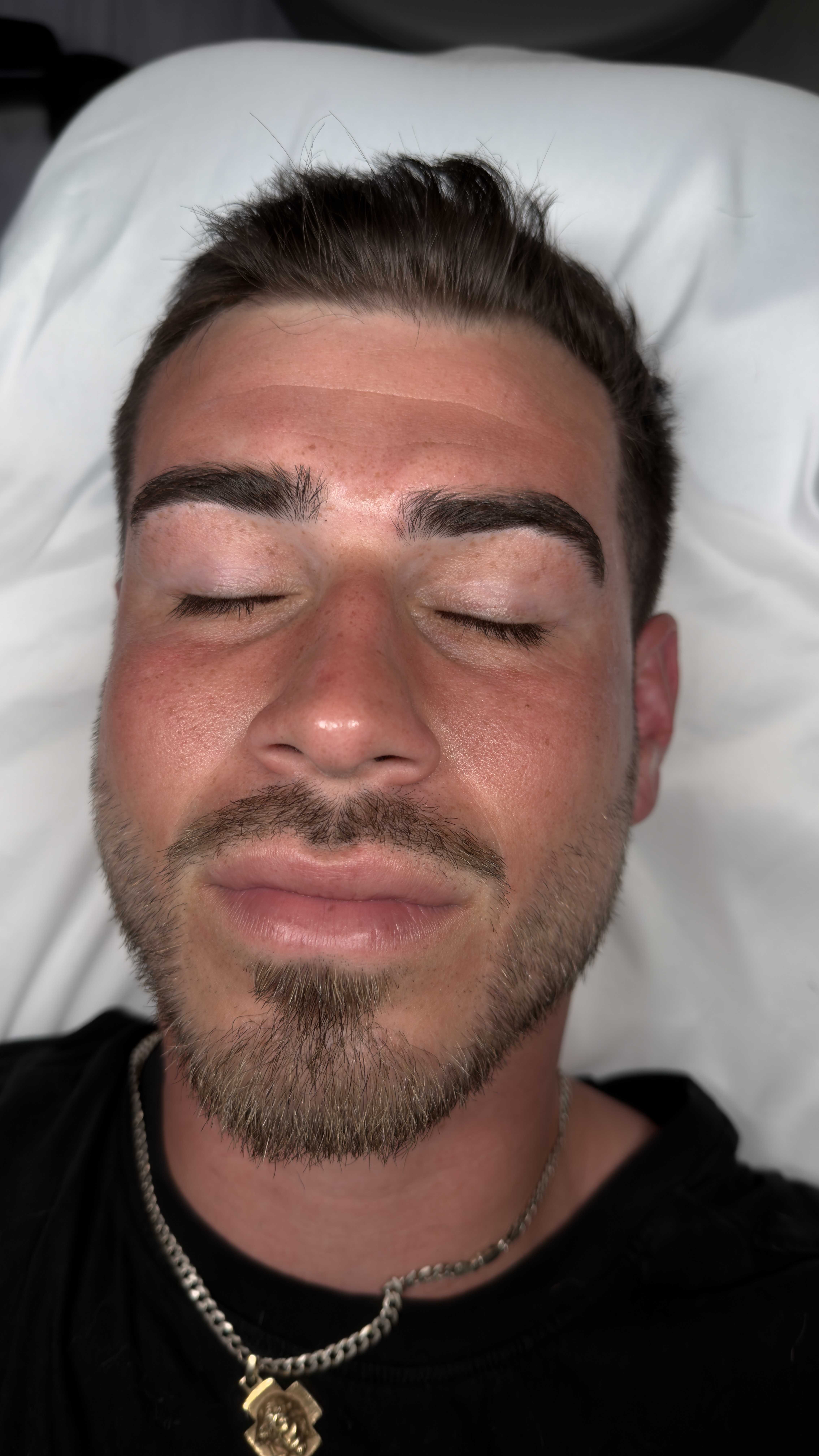After HydraFacial