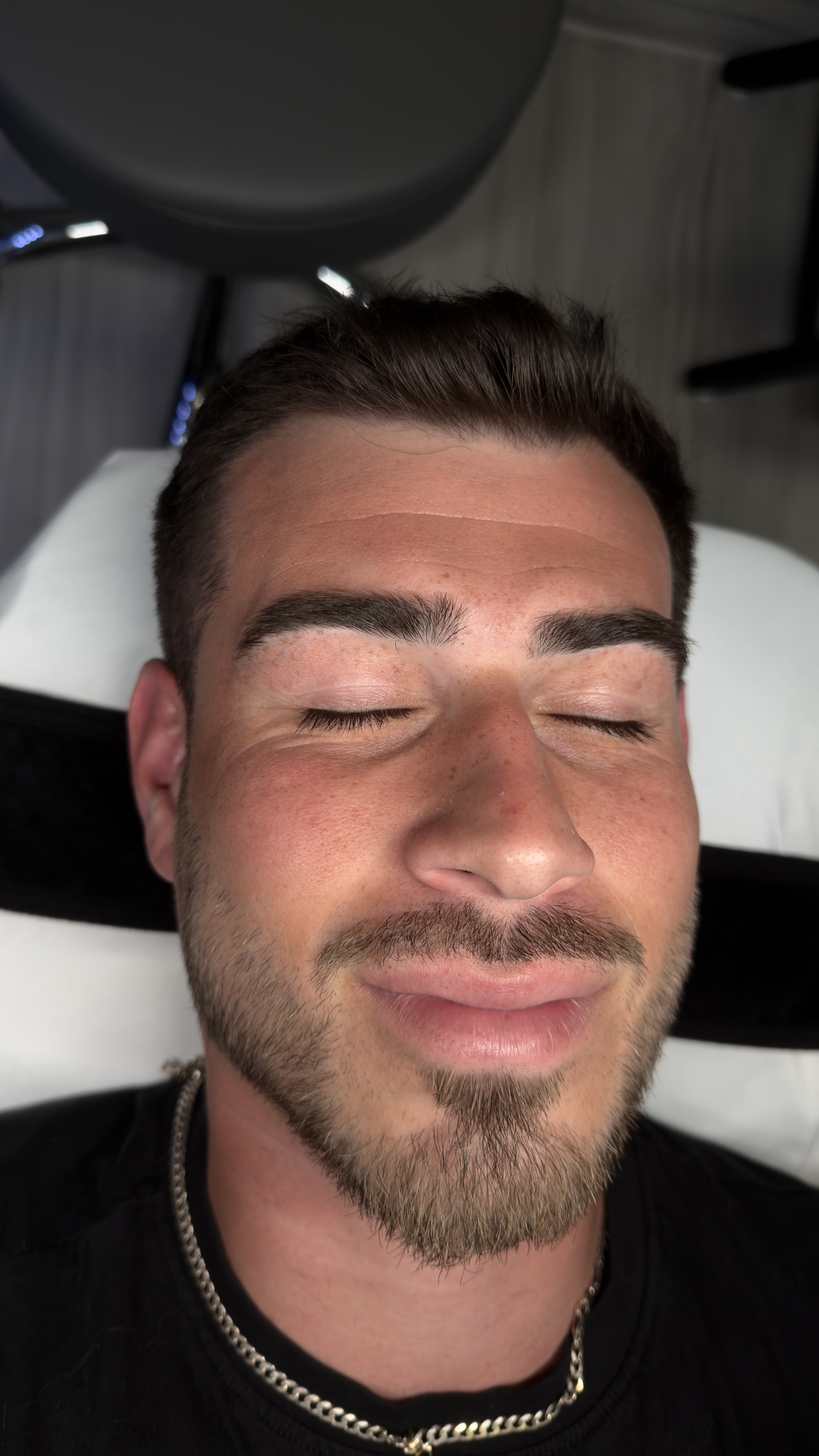 Before HydraFacial